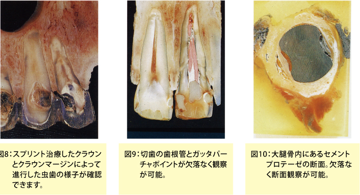 歯と大腿骨内にあるセメントプロテーゼの断面画像